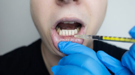 récession gingivale.jpg